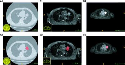 The value of combined PET/MRI, CT and clinical metabolic parameters in differentiating lung adenocarcinoma from squamous cell carcinoma